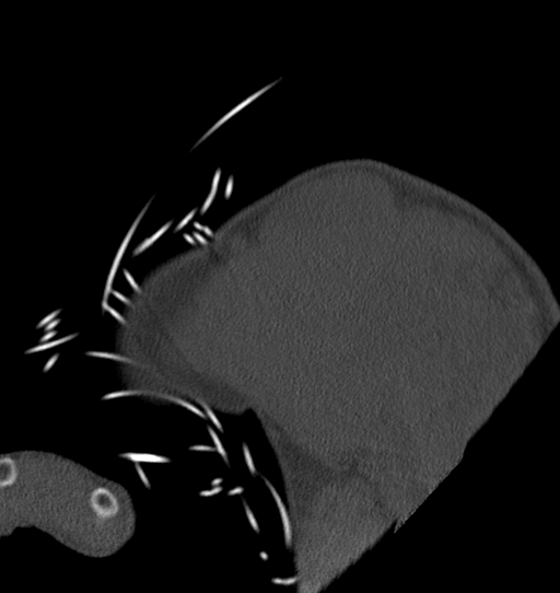 Anterior shoulder dislocation with Hill-Sachs and bony Bankart lesions (Radiopaedia 40424-42974 Sagittal bone window 9).png