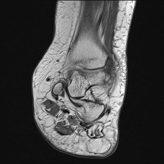 File:Anterior talofibular ligament injury - rupture with soft-tissue impingement (Radiopaedia 38765-40928 Coronal PD 20).jpg