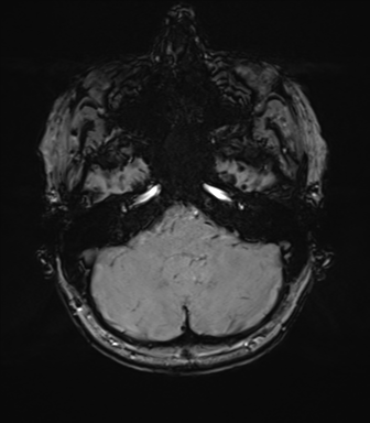 Anterior temporal lobe perivascular space (Radiopaedia 40946-43650 Axial SWI 17).png