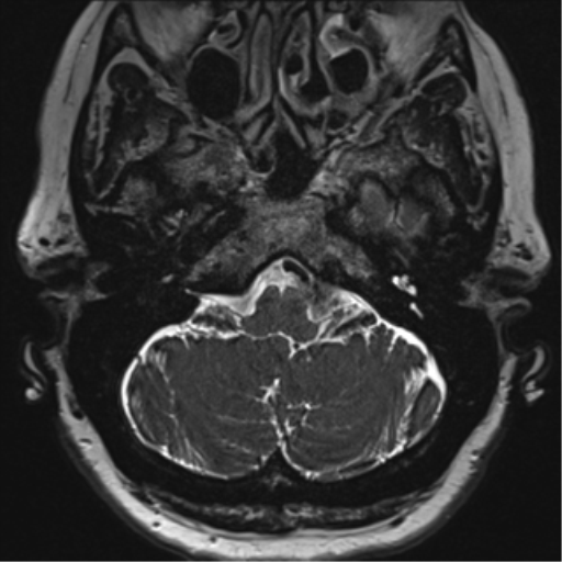 File:Anterior temporal pole cysts (Radiopaedia 46629-51102 Axial T2 21).png