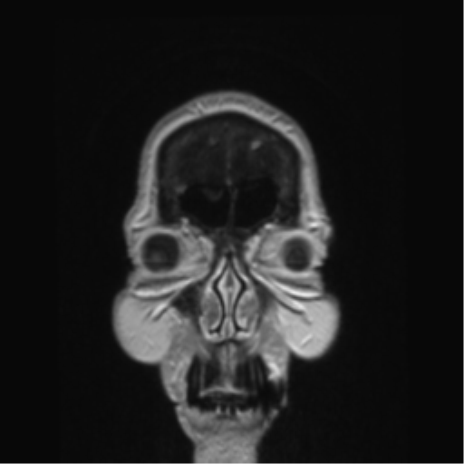 Anterior temporal pole cysts (Radiopaedia 46629-51102 Coronal T1 C+ 167).png