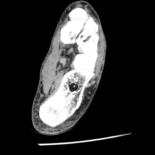 Anterior tibial artery false aneurysm (Radiopaedia 88984-105809 A 194).jpg