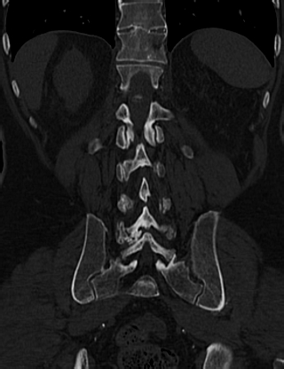 File:Anterior vertebral scalloping (abdominal aortic aneurysm) (Radiopaedia 66744-76067 Coronal bone window 54).jpg