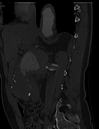 File:Anterior vertebral scalloping (abdominal aortic aneurysm) (Radiopaedia 66744-76067 Sagittal bone window 2).jpg