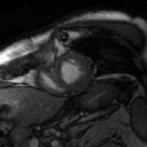 File:Anteroseptal hypokinesia after myocardial infarction (Radiopaedia 15978-15633 Short axis SSFE 7).jpg