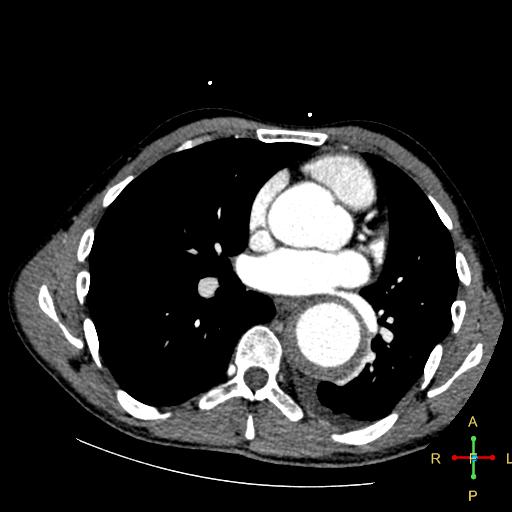 File:Aortic aneurysm and penetrating ulcer (Radiopaedia 23590-23704 A 19).jpg