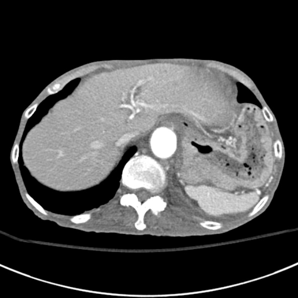 File:Aortic aneurysm with spinal destruction (Radiopaedia 42301-45410 A 17).jpg