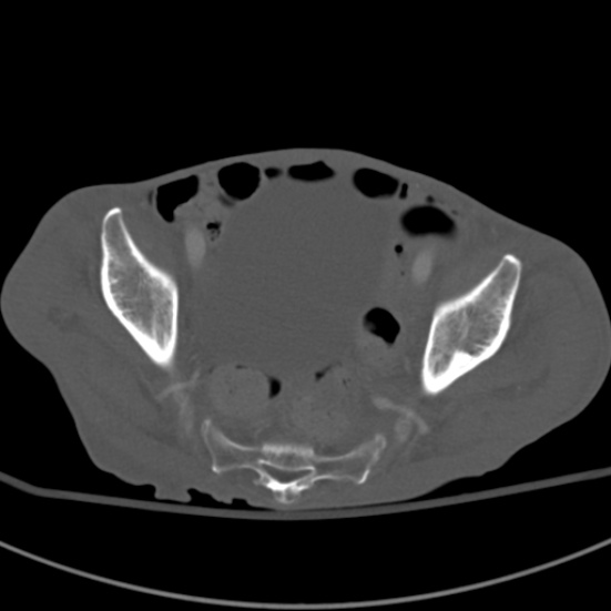 Aortic aneurysm with spinal destruction (Radiopaedia 42301-45410 Axial bone window 93).jpg