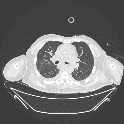 Aortic arch aneurysm (Radiopaedia 84109-99365 Axial lung window 127).jpg