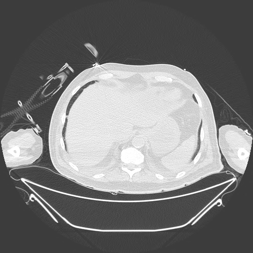 Aortic arch aneurysm (Radiopaedia 84109-99365 Axial lung window 239).jpg