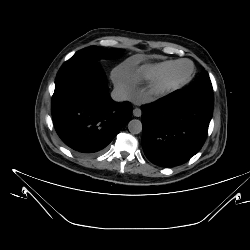 Aortic arch aneurysm (Radiopaedia 84109-99365 Axial non-contrast 214).jpg