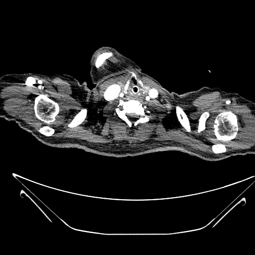Aortic arch aneurysm (Radiopaedia 84109-99365 B 4).jpg
