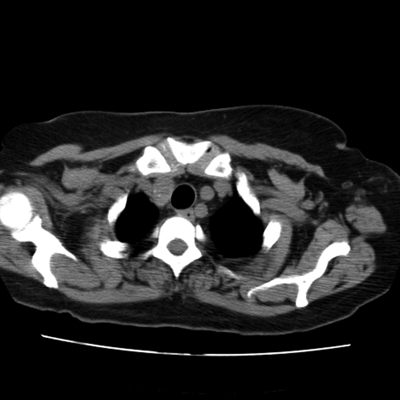 Aortic arch pseudoaneurysm (Radiopaedia 8534-9368 Axial non-contrast 4).jpg