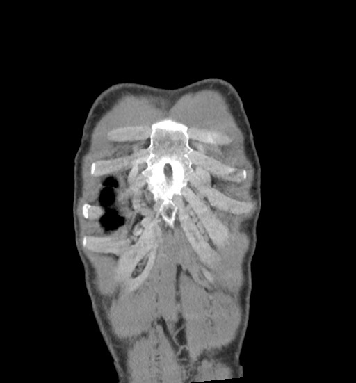 Aortic coarctation with aneurysm (Radiopaedia 74818-85828 C 11).jpg