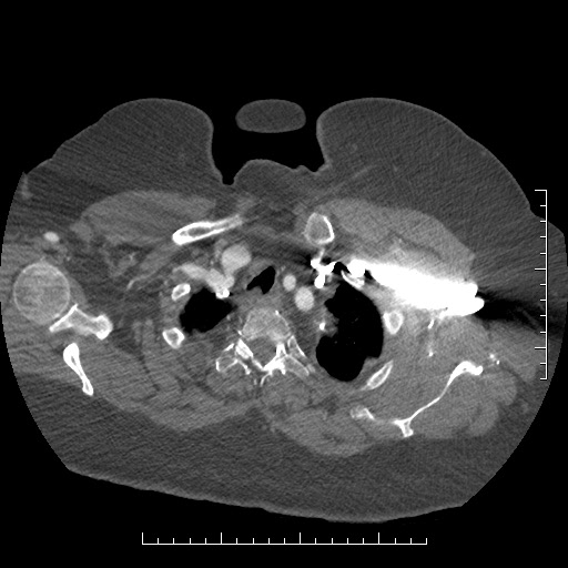 File:Aortic dissection- Stanford A (Radiopaedia 35729-37268 A 2).jpg