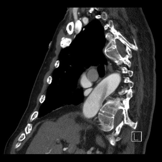 File:Aortic dissection (CTPA) (Radiopaedia 75506-86750 C 43).jpg