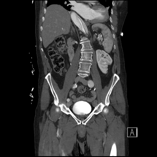 Aortic dissection (CTPA) (Radiopaedia 75506-86750 F 37).jpg