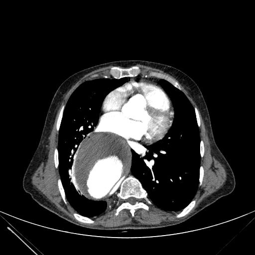 Aortic dissection (Radiopaedia 27466-27665 C+ arterial phase 162).jpg