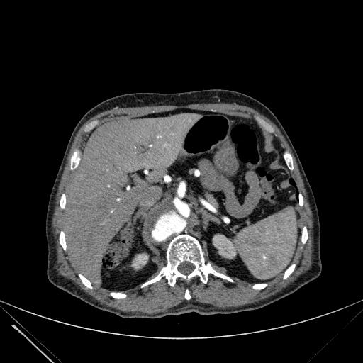 Aortic dissection (Radiopaedia 27466-27665 C+ arterial phase 288).jpg