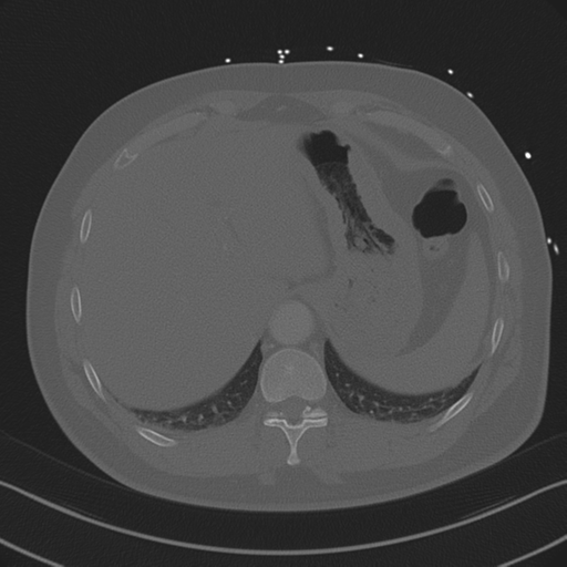 Aortic dissection (Radiopaedia 50763-56234 Axial bone window 89).png