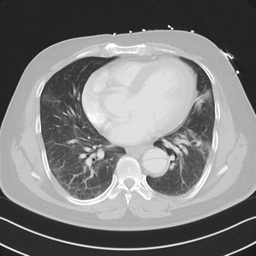 File:Aortic dissection (Radiopaedia 50763-56234 Axial lung window 41).png