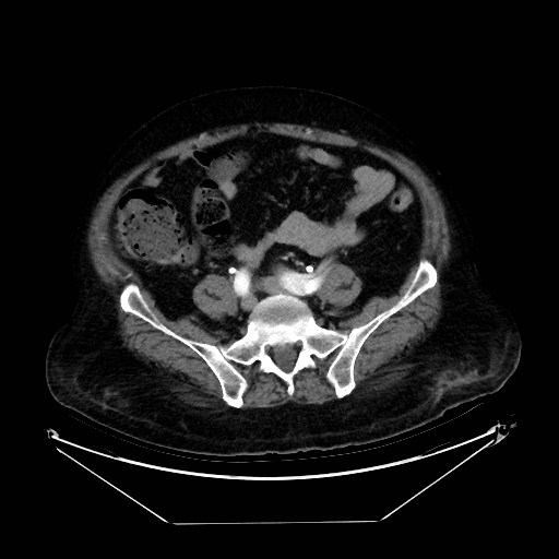Aortic dissection (Radiopaedia 62562-71000 A 87).jpg