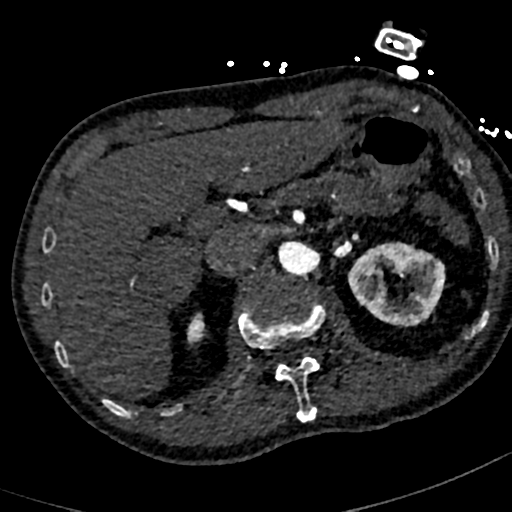 File:Aortic dissection - DeBakey type II (Radiopaedia 64302-73082 A 94).png