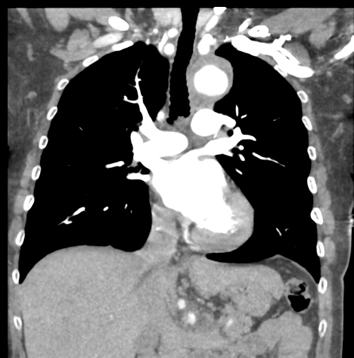 File:Aortic dissection - Stanford type B (Radiopaedia 50171-55512 B 41).png