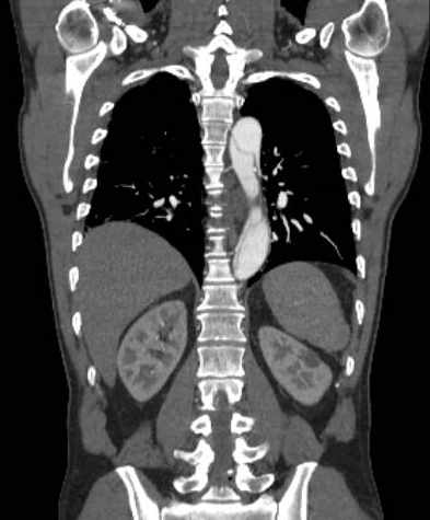 File:Aortic dissection - Stanford type B (Radiopaedia 73648-84437 B 84).jpg