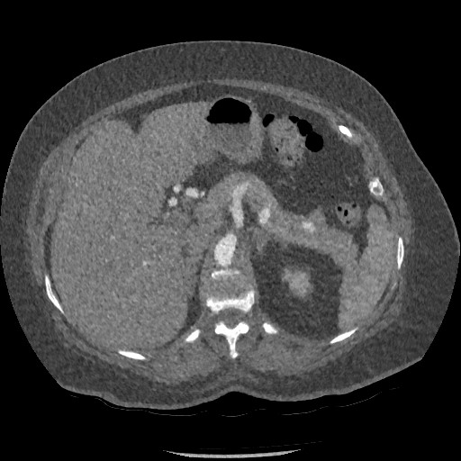 File:Aortic dissection - Stanford type B (Radiopaedia 88281-104910 A 104).jpg