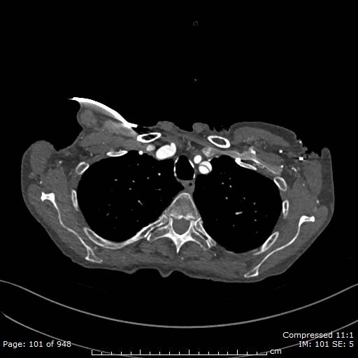 File:Aortic dissection with extension into aortic arch branches (Radiopaedia 64402-73204 B 101).jpg