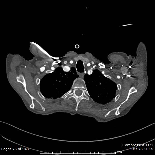 File:Aortic dissection with extension into aortic arch branches (Radiopaedia 64402-73204 B 76).jpg