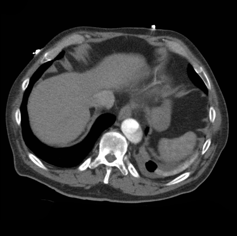 Aortic dissection with rupture into pericardium (Radiopaedia 12384-12647 A 46).jpg