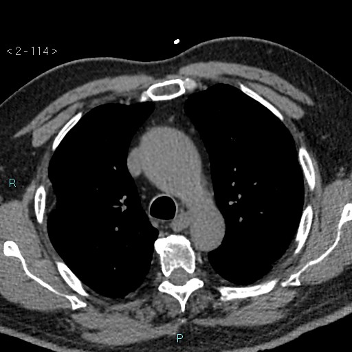 Aortic intramural hematoma (Radiopaedia 48463-53380 Axial non-contrast 50).jpg