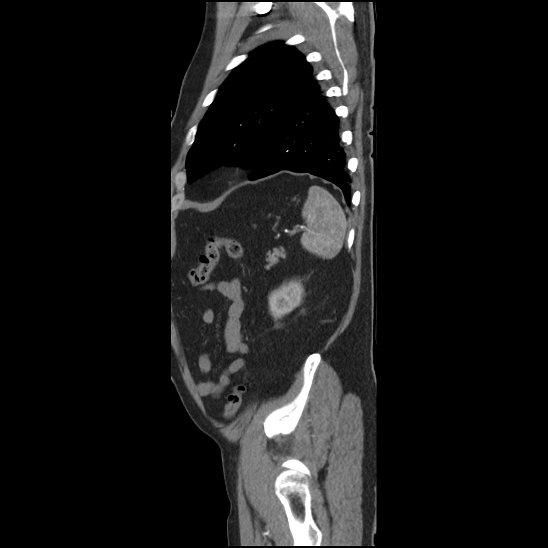 Aortic intramural hematoma (type B) (Radiopaedia 79323-92387 H 47).jpg