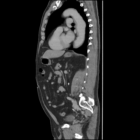 Aortic intramural hematoma (type B) (Radiopaedia 79323-92387 Sagittal C+ delayed 32).jpg