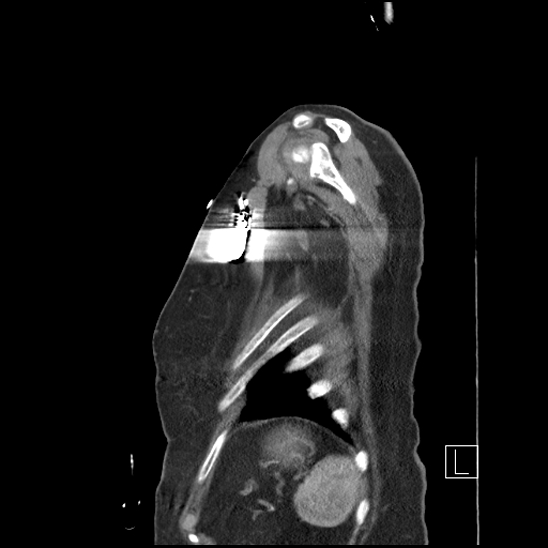 Aortic intramural hematoma with dissection and intramural blood pool (Radiopaedia 77373-89491 D 82).jpg