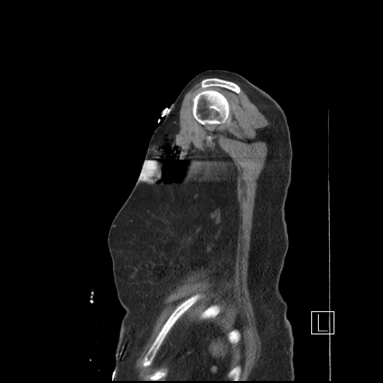 File:Aortic intramural hematoma with dissection and intramural blood pool (Radiopaedia 77373-89491 D 87).jpg