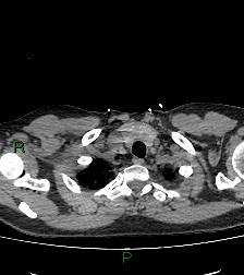 File:Aortic valve endocarditis (Radiopaedia 87209-103485 Axial non-contrast 14).jpg
