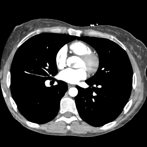 File:Aortic valve non-coronary cusp thrombus (Radiopaedia 55661-62189 A 12).png