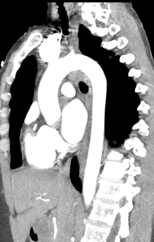 Aortic valve non-coronary cusp thrombus (Radiopaedia 55661-62189 C+ arterial phase 29).png