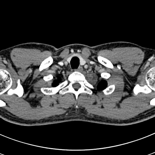 File:Apical lung mass mimic - neurogenic tumor (Radiopaedia 59918-67521 A 5).jpg