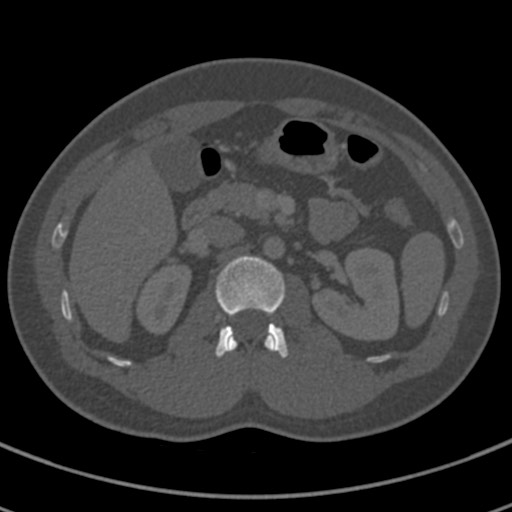 Apical lung mass mimic - neurogenic tumor (Radiopaedia 59918-67521 Axial bone window 94).jpg