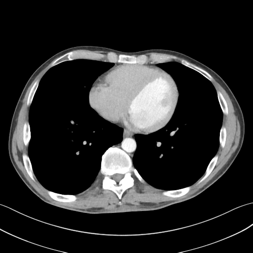 Apical pleural calcification (Radiopaedia 46141-50499 Axial C+ delayed 47).png