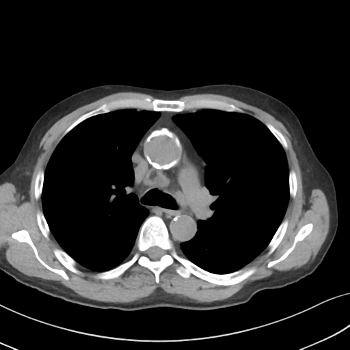 Apical pulmonary metastasis (Radiopaedia 46338-50754 B 27).png