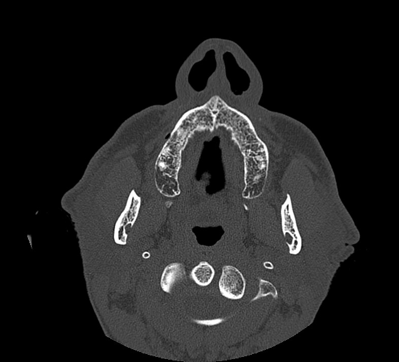 Aplastic maxillary sinuses (Radiopaedia 60030-67561 Axial non-contrast 6).jpg
