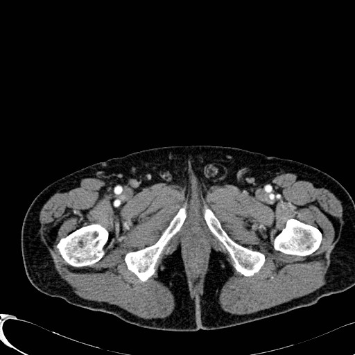 Appendiceal adenocarcinoma complicated by retroperitoneal abscess (Radiopaedia 58007-65039 B 153).jpg