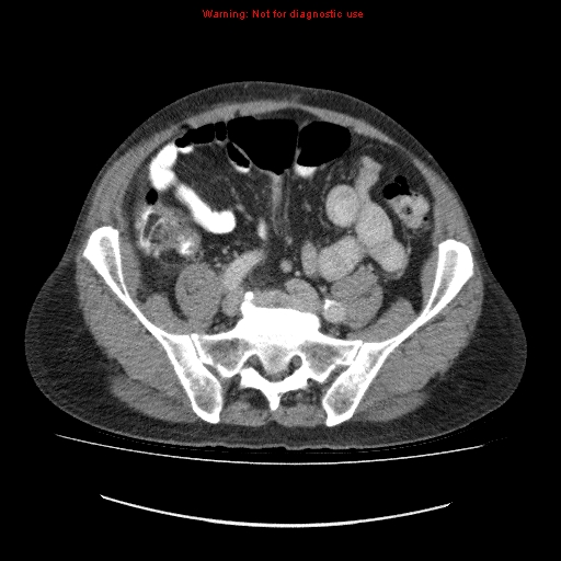 File:Appendicitis mass in inguinal hernia (Radiopaedia 26858-27029 A 7).jpg