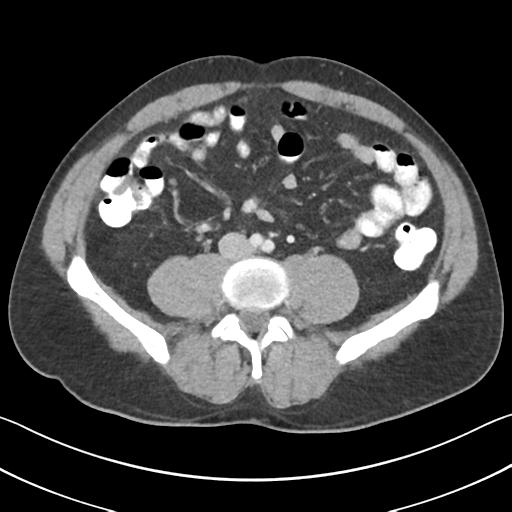 Appendicitis with cecal bar sign (Radiopaedia 31878-32830 B 49).jpg