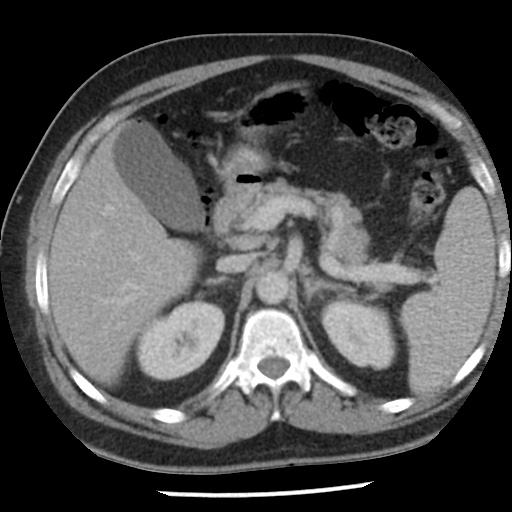 Appendicitis with perforation (Radiopaedia 35790-37342 A 14).jpg